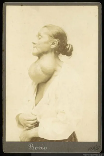 Bocio — 1900 | Chile de Ayer